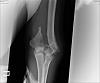 Broken Arm Xray-xray-4.jpg